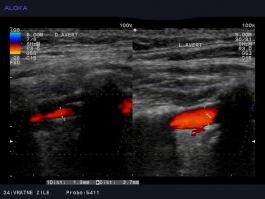 Ultrazvok vratnih žil - prirojeno ožja desna vertebralna arterija